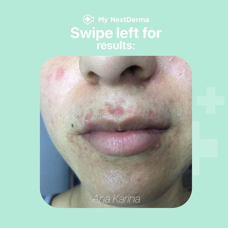 MyNextDerma's tweet photo. #happyclients 💆‍♀️✨ Les compartimos el ANTES &amp; DESPUÉS de Ana Karina!
¡Gracias Karina! 🤩✨ #MyNextDerma https://t.co/qkNmd0xfPb