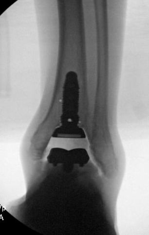 How it started
How its going
#OrthoTwitter #AnkleReplacement