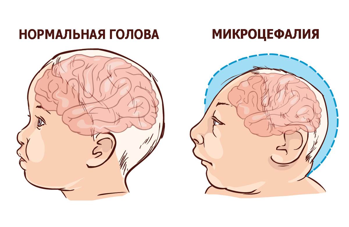 Заболевание головного мозга у детей