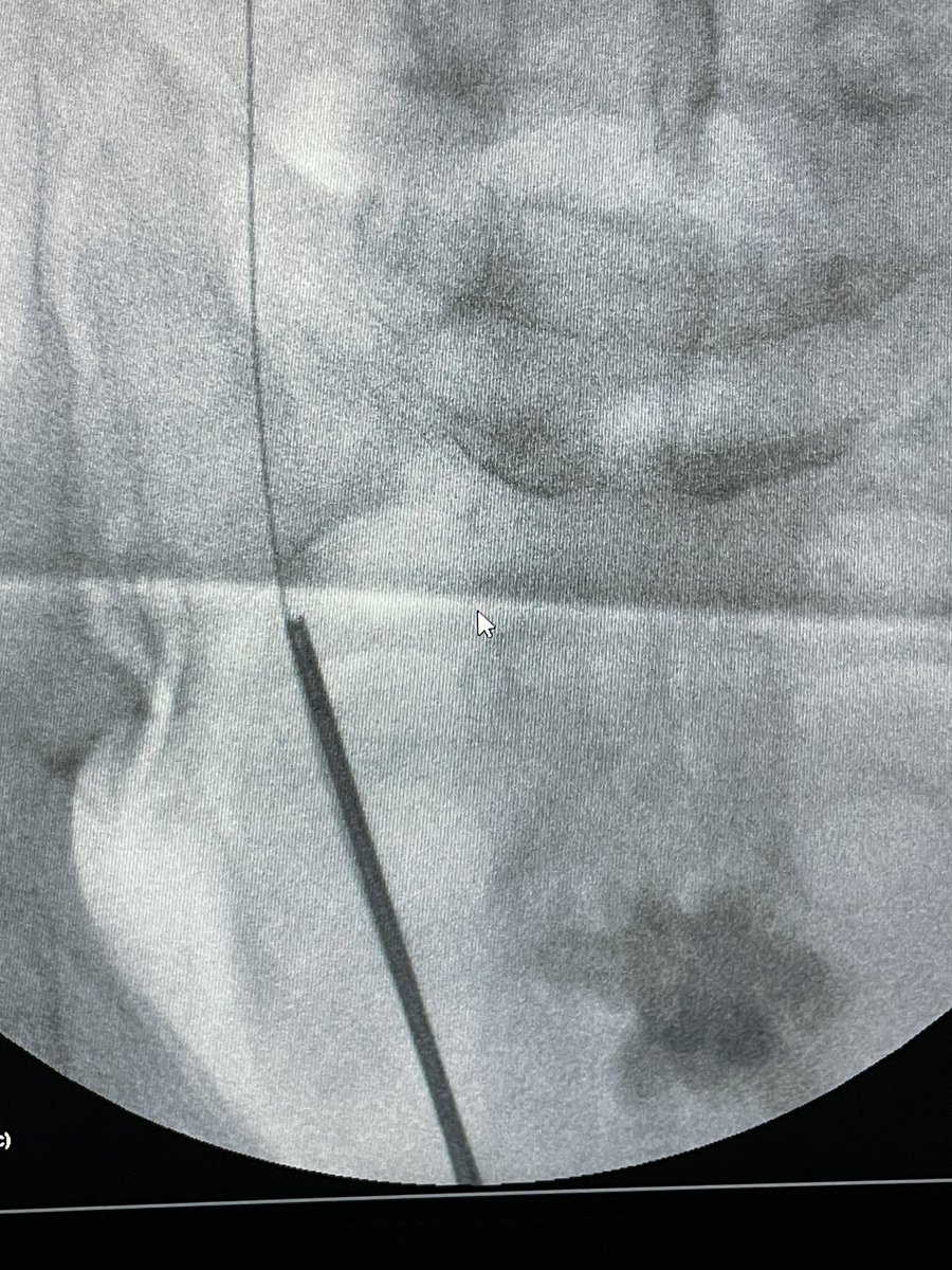 aurologyauth's tweet photo. Testing the new Super-Pulse Thulium Fiber Laser System "SOLTIVE Premium" by @OlympusUrology in 9 URS/RIRS cases. 🏥@aurologyauth 
👉@anastasios_dr , @Memmos4 , @i_mykoniatis, @sountp, @evangelos_n https://t.co/qelLPebNQi