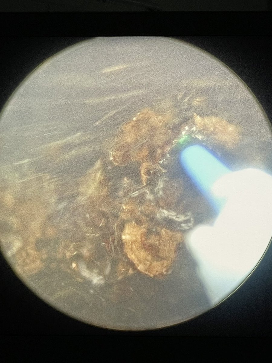 aurologyauth's tweet photo. Testing the new Super-Pulse Thulium Fiber Laser System "SOLTIVE Premium" by @OlympusUrology in 9 URS/RIRS cases. 🏥@aurologyauth 
👉@anastasios_dr , @Memmos4 , @i_mykoniatis, @sountp, @evangelos_n https://t.co/qelLPebNQi