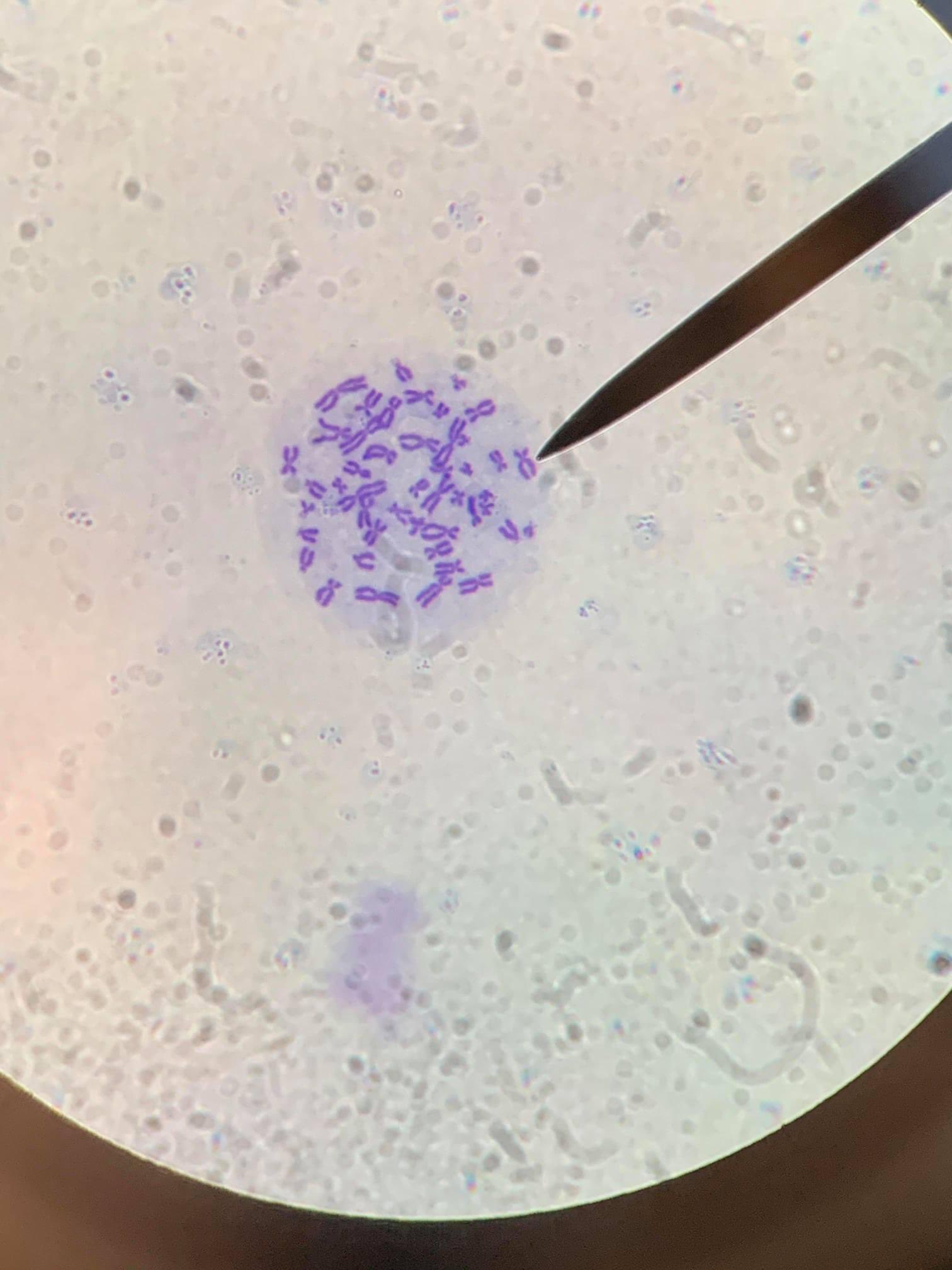Cromosoma humano bajo el microscopio. Fue genial ver mis propios cromosomas. Pasé un buen tiempo mirando a través del microscopio. Pensé en compartir uno de los momentos "woah". Ampliación de 1000x ampliación de la cámara del iPhone 2x, ocular de 10x e inmersión en aceite de 100x https://t.co/YYBI67cQlX