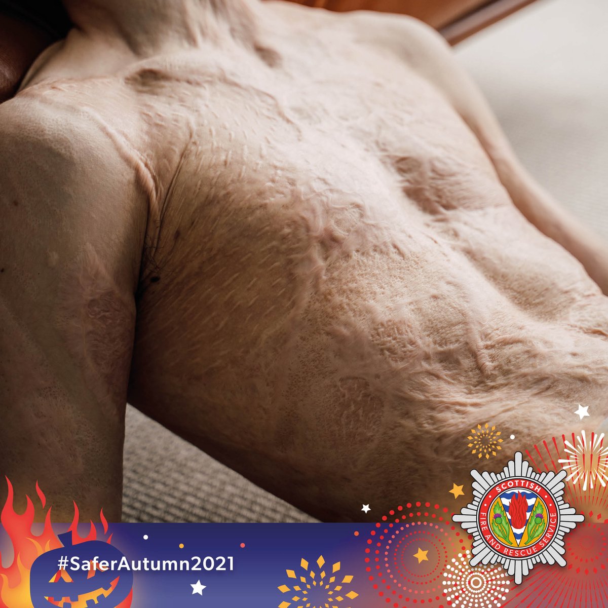 fire_scot's tweet photo. ⚠️ Most hospital admissions because of fireworks involve children. 
 
Please consider the risks of having a home firework display this year. 
 
The consequences can be devastating.  
 
More here: https://t.co/SutXvTl2Gs 
 
#SaferAutumn2021 https://t.co/4i1kRi1lGL