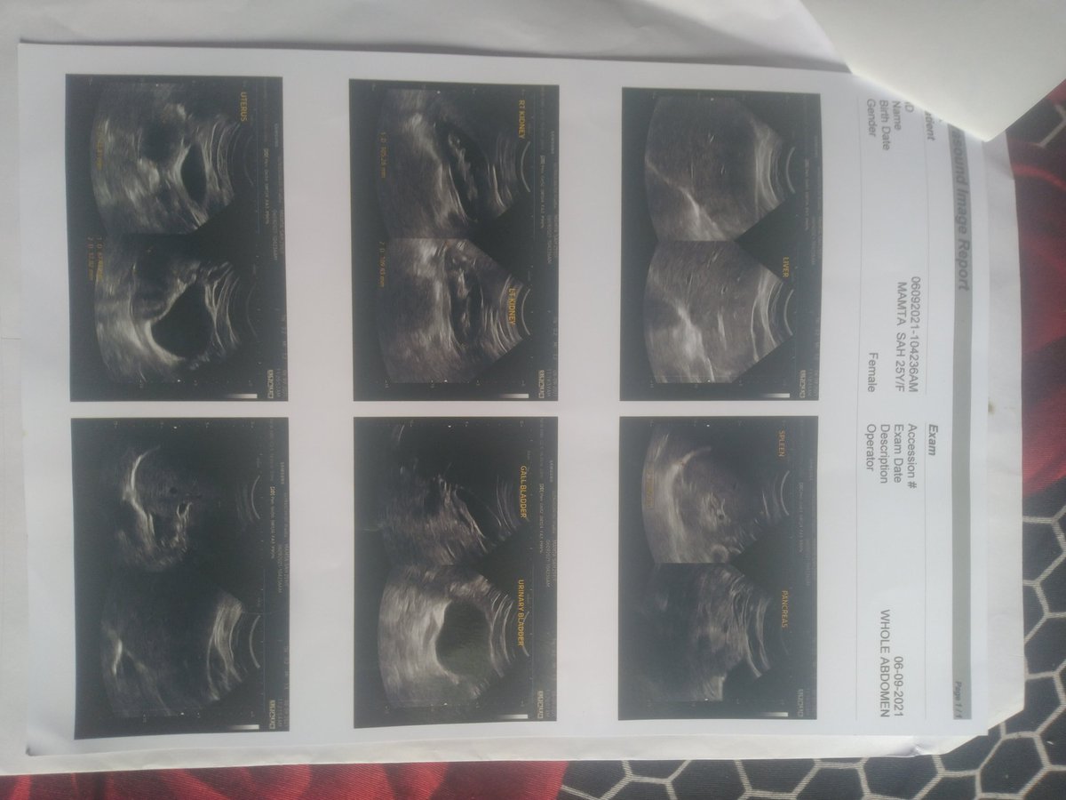 ShivSah18651223's tweet photo. @AamirBrigade sir plz i wants to raise funds for My Wife Is Fighting For Her Life And We Need Your Support To Save Her. Your donation has the power to help them move closer to their goal amount. Please contribute. Plz help me sir my Google pay or phone pay no +917002876109🙏🙏🙏 https://t.co/Y8pCxldLSq