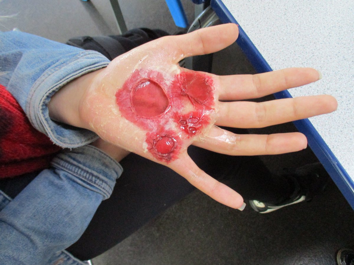 springfieldpru's tweet photo. In hair and beauty we have been raising awareness for National Burns Day by creating the effects of burns using SFX make-up. We have been focusing on how the effects for burns are life long and the steps we can take to keep safe. #BeBurnsAware #sprBTEC https://t.co/n3E41F4lxq