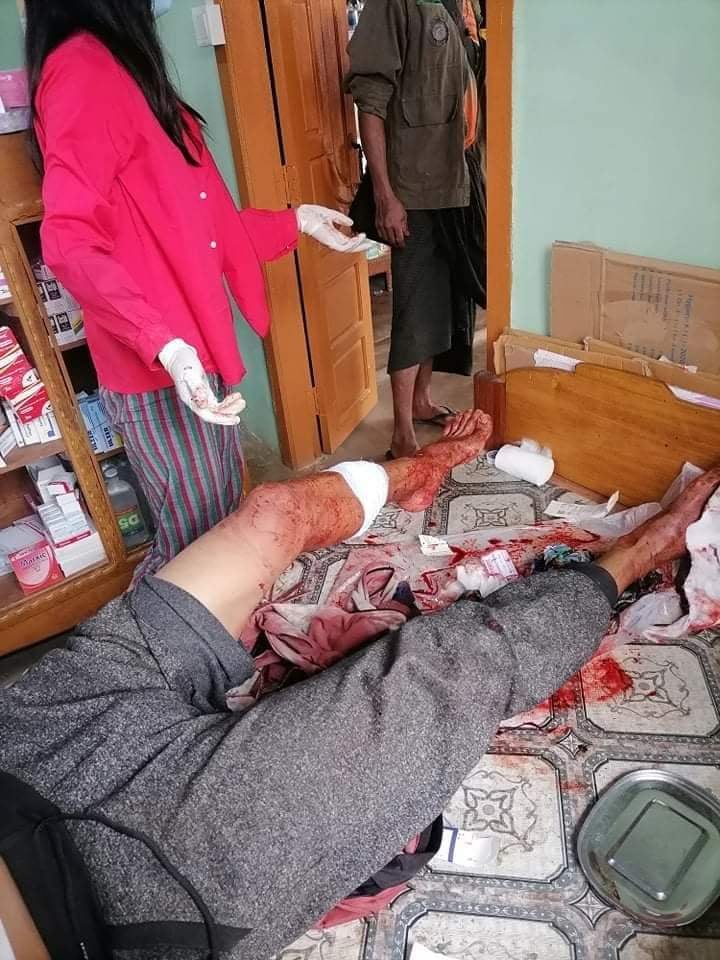 IrrawaddyNews's tweet photo. Three civilians were injured after stepping on a mine on Wednesday morning in Kayah State’s Loikaw Township. (Photo: Shwe Loikaw Humanitarian Association) 

#WhatsHappeningInMyanmar https://t.co/zfpNjYz7Is