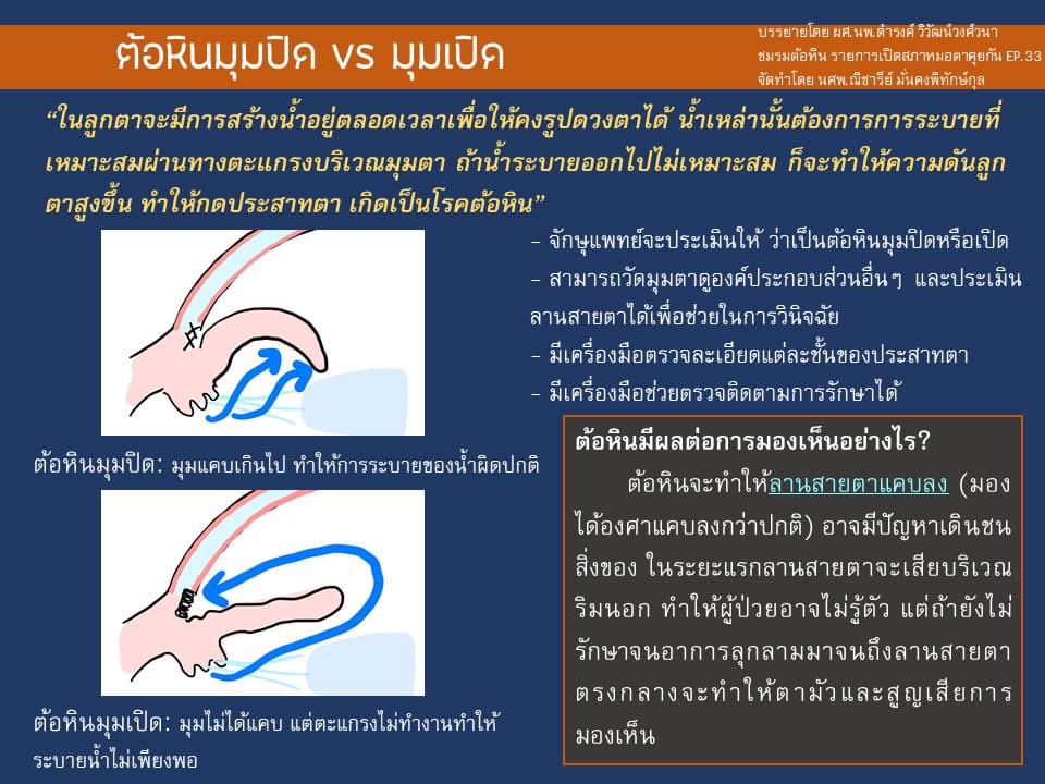 DrSasiYaisawang's tweet photo. [EP31] #ต้อหิน น่ากลัว! รักษาได้ไหม ต้องทำยังไง?

#เปิดสภาหมอตาคุยกัน 
Repost จาก #ราชวิทยาลัยจักษุแพทย์แห่งประเทศไทย https://t.co/LnJSXxEc4B