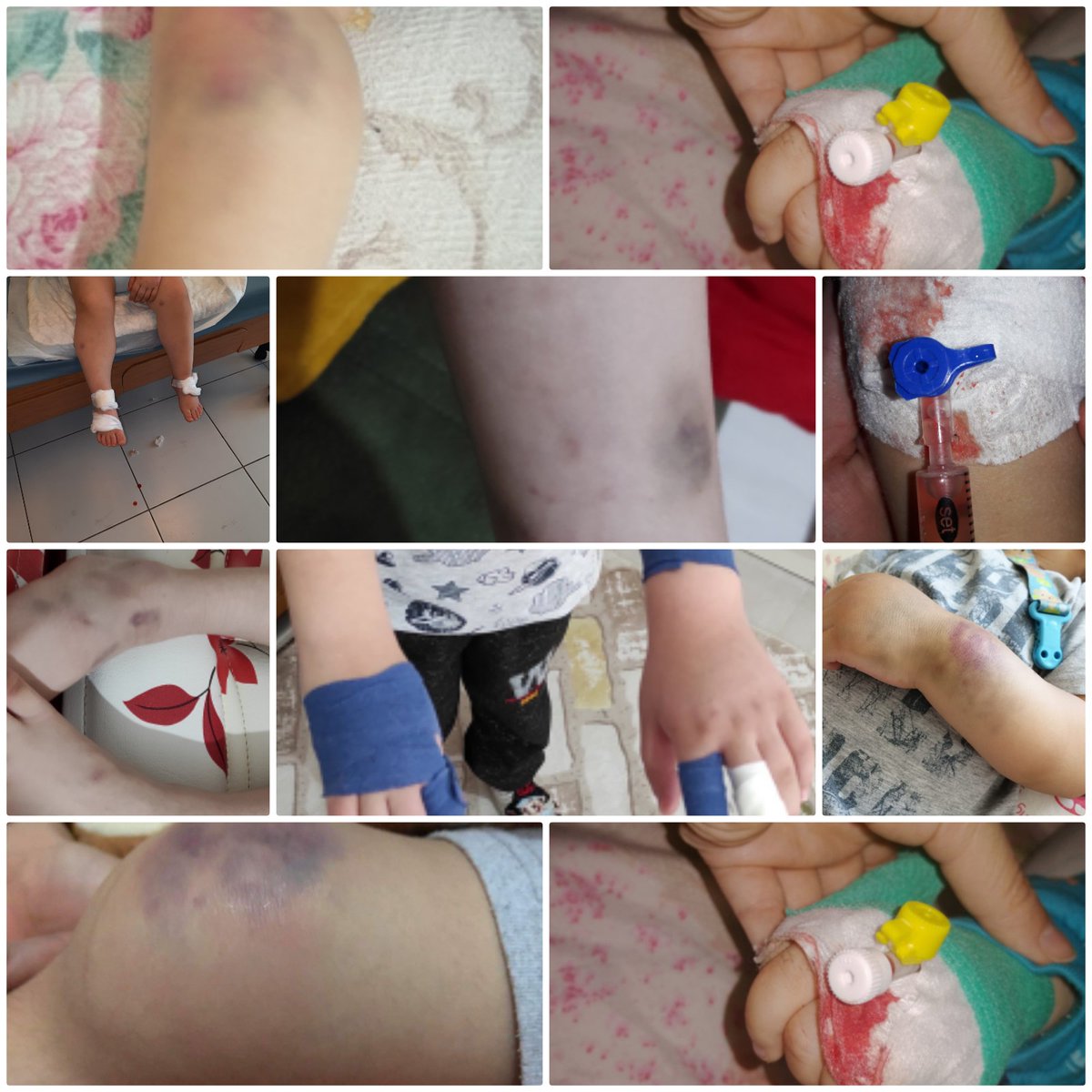 lotustab12's tweet photo. @sgksosyalmedya Vicdan artık,çocukların sesine ve acılarına ısrarla kulak tıkayan  #sgksosyalmedya. #hemofili tanılı çocuklar #derialtı ilaç bekliyor 2 yıldır.Etkin tedaviden yoksun bırakmakta ısrar ediyorsunuz. Hani ekonomisi güçlü bir ülkeydik? #vedatbilgn #cceylan58 #csgbakanligi #ASHB_COCUK https://t.co/MutWFxOe8q