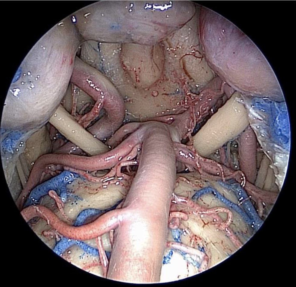 #Endoscopic view of the #basilar artery and the floor of the third ventricle #Neuroanatomy #Cerebrovascular 
Source: <a href="/AaronCohenGadol/">Aaron Cohen-Gadol, MD</a>