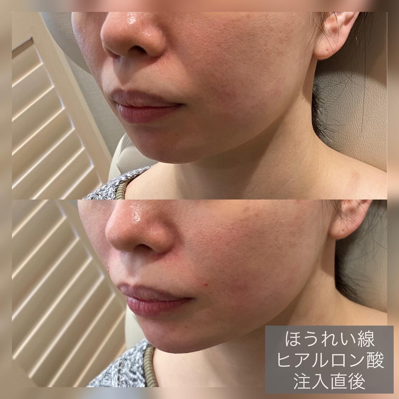 Rejuva 表参道レジュバメディカルクリニック 肌管理 膣管理 アートメイク エステ 美容点滴 ほうれい線ヒアルロン酸注入 症例 ほうれい線両側に合計ボリフト1cc注入 少しだけで印象が変わりますね ヒアルロン酸注入で 気をつけたいことは 入れすぎ