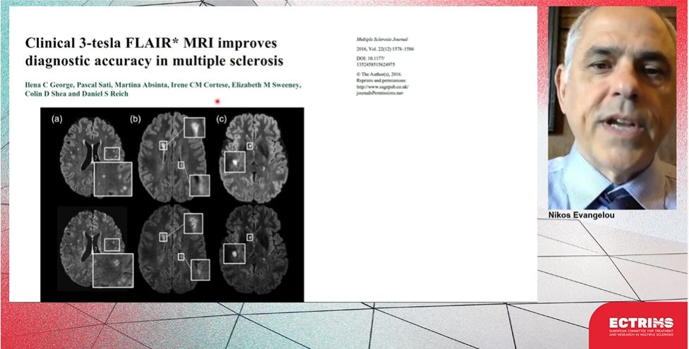 Barry Singer MD 🧠 (@drbarrysinger) on Twitter photo Central vein sign #CVS on MRI likely will decrease misdiagnosis of MS. Useful to predict radiological isolated syndrome conversion to MS. Studies ongoing to see if #CVS should be added to MS diagnostic criteria. <a href="/nikosevangelou3/">nikosevangelou3</a> #ECTRIMS2021 Central vein sign #CVS on MRI likely will decrease misdiagnosis of MS. Useful to predict radiological isolated syndrome conversion to MS. Studies ongoing to see if #CVS should be added to MS diagnostic criteria. <a href="/nikosevangelou3/">nikosevangelou3</a> #ECTRIMS2021
