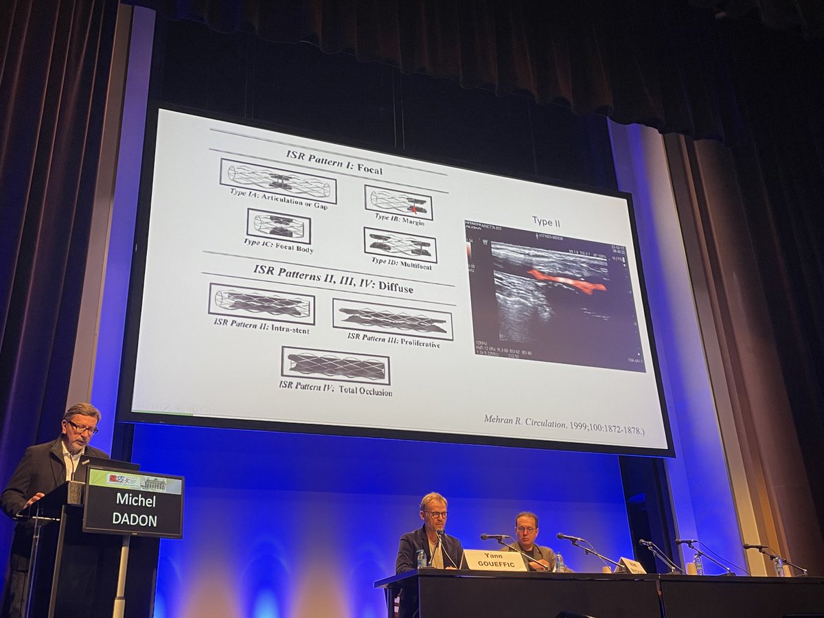 GMahe_'s tweet photo. #cfpv21 how to classify intrastent stenosis ? @MichelDadon https://t.co/irhh2bo9TI