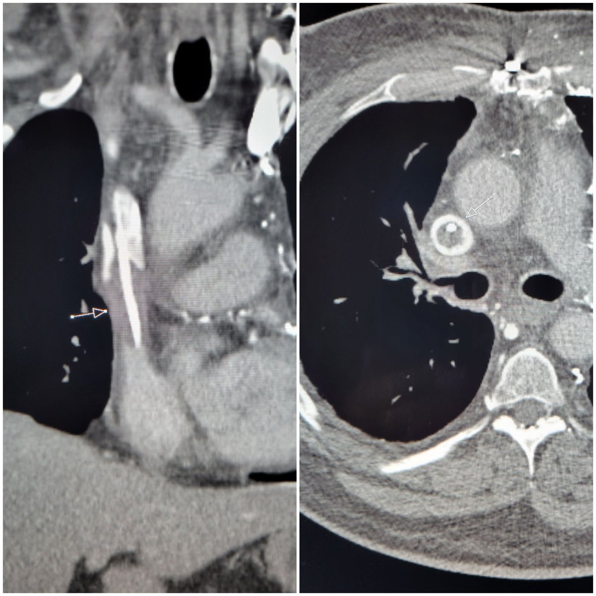 TempleRADs's tweet photo. Patient w/catheter assoc thrombus and SVC syndrome. Failed TPA lysis. Cleared with Inari Clottriever via right brachial vein access. Basket OTW into IVC.Huge organized thrombus/fibrin removed w/resolved flow! Fantastic job @spratipat. @TempleRadRes @SIR_ECS @SIRRFS  @InariMedical https://t.co/fmMfmT4DKA