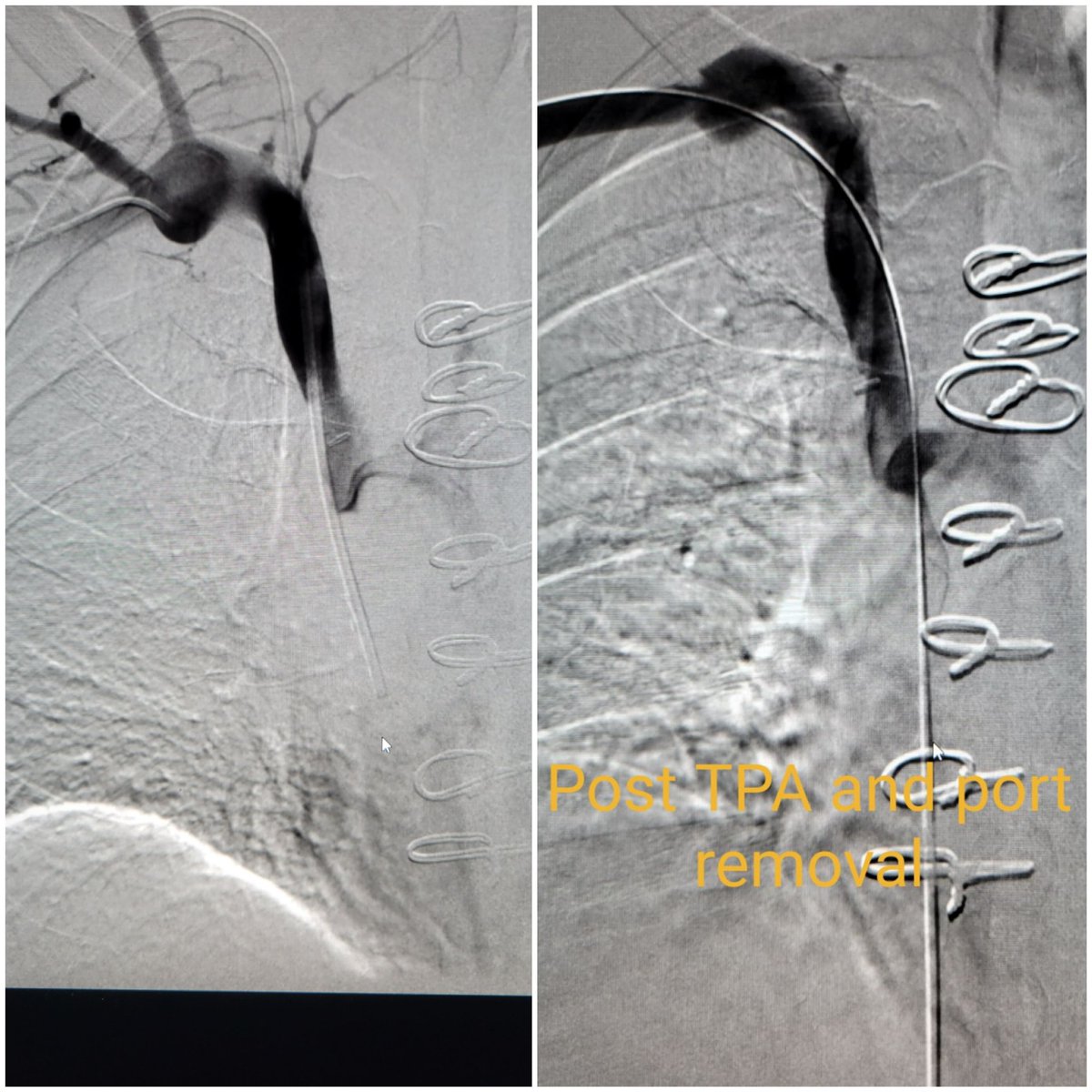 TempleRADs's tweet photo. Patient w/catheter assoc thrombus and SVC syndrome. Failed TPA lysis. Cleared with Inari Clottriever via right brachial vein access. Basket OTW into IVC.Huge organized thrombus/fibrin removed w/resolved flow! Fantastic job @spratipat. @TempleRadRes @SIR_ECS @SIRRFS  @InariMedical https://t.co/fmMfmT4DKA