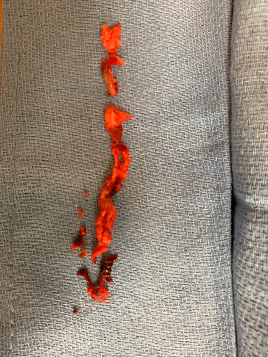 TempleRADs's tweet photo. Patient w/catheter assoc thrombus and SVC syndrome. Failed TPA lysis. Cleared with Inari Clottriever via right brachial vein access. Basket OTW into IVC.Huge organized thrombus/fibrin removed w/resolved flow! Fantastic job @spratipat. @TempleRadRes @SIR_ECS @SIRRFS  @InariMedical https://t.co/fmMfmT4DKA