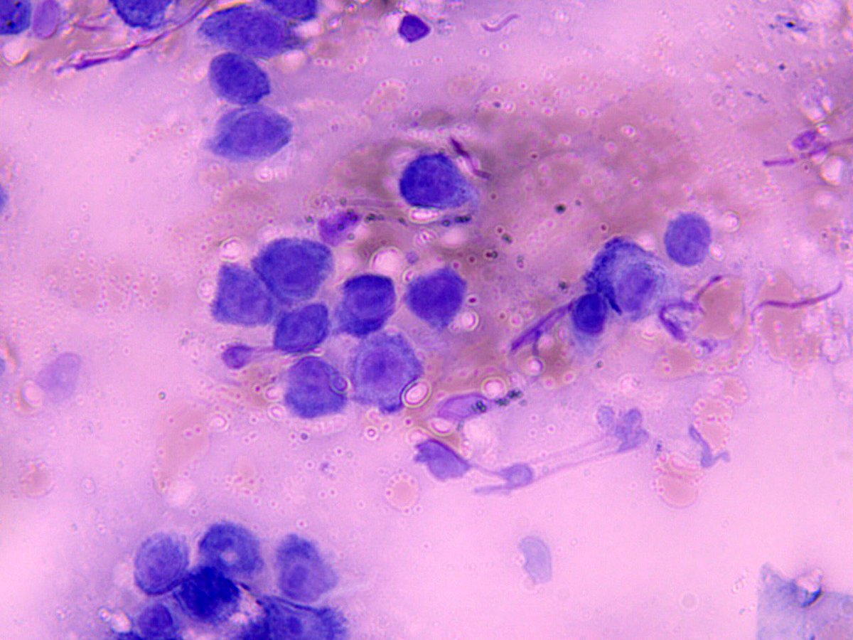 Penfigo foliaceo clínica y citología Wright-Giemsa de célula de Tzanck : células epiteliales acantoliticas redondeadas, con halo perinuclear y condensación periférica del citoplasma .