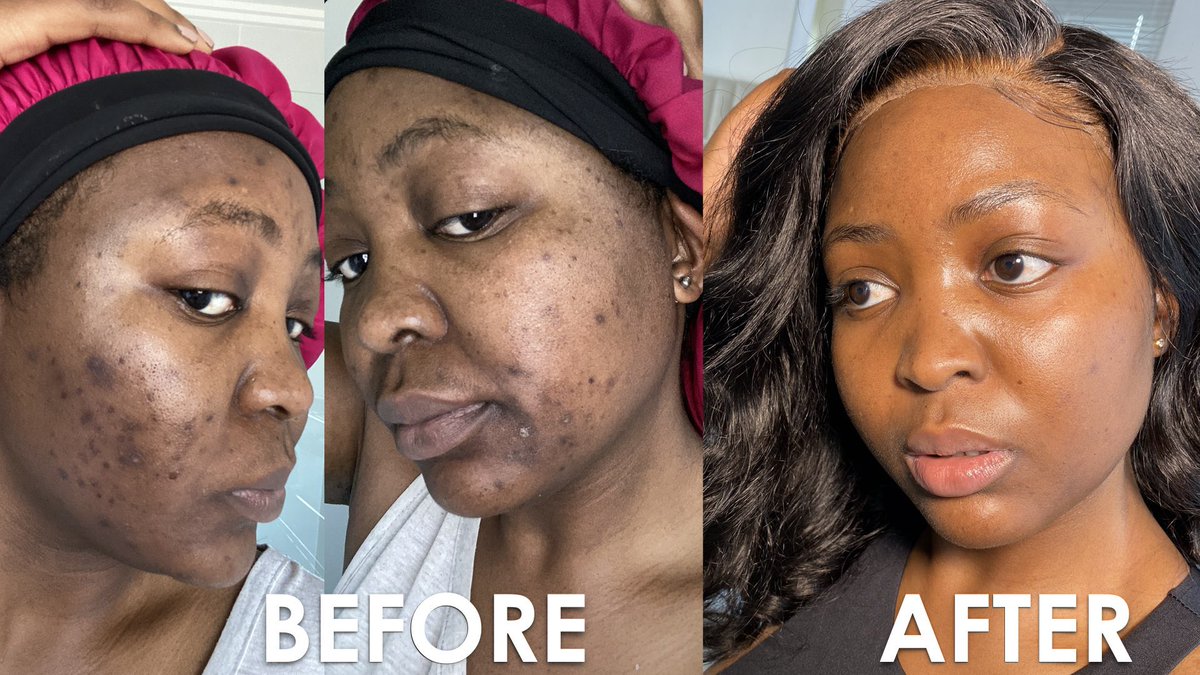 Thandi_Gama's tweet image. HOW I CLEARED MY ACNE | MY 6 MONTHS ORATANE / ACCUTANE JOURNEY AND HORRI... youtu.be/fVJgCMeJFQk via @YouTube