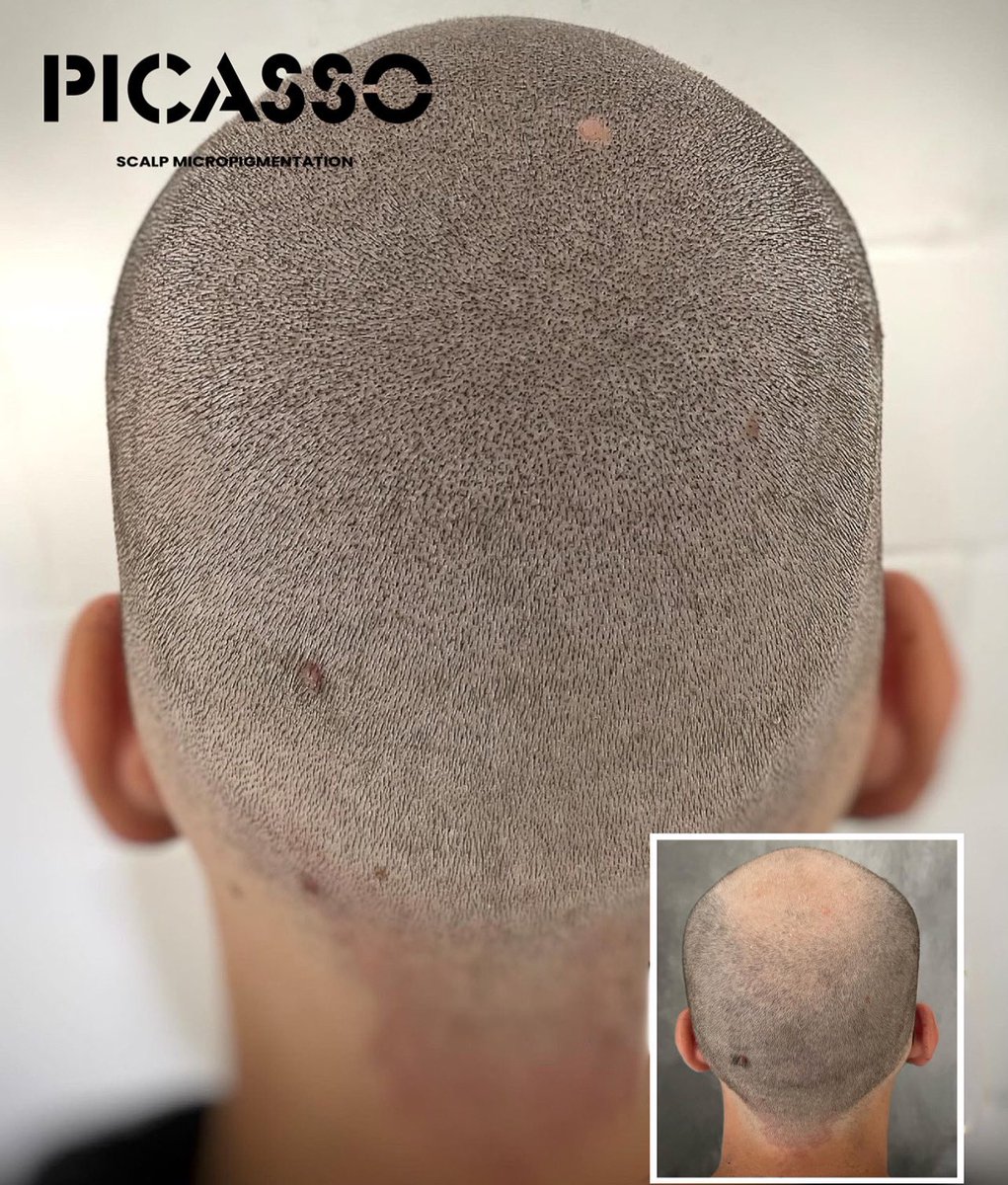 picassojef's tweet photo. • @tieli ⚔️⚡️⚔️ Back it up 👌🏾
•
•
•
•
•
Pigment: @ghostpigment (use code: KAT for discount)
Needles: @fytsmpofficial
Classes: @ldrsmp
•
•
#naturalhairline
#touchup
#alopecia
#naturalresults
#malepatternhairloss
#hairtransplant
#baldingsolution https://t.co/m7ItCsiqOo