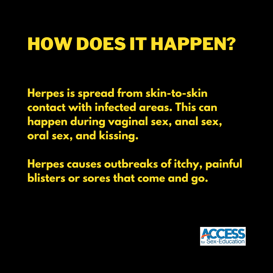 AccessforSexEd's tweet photo. This #HerpesAwarenessDay let's talk about what herpes is, how it happens, and how it is treated.
#AccessForSexEd #SexEd #Herpes #Awareness #StopTheStigma #STI https://t.co/zj8ROS6kTl