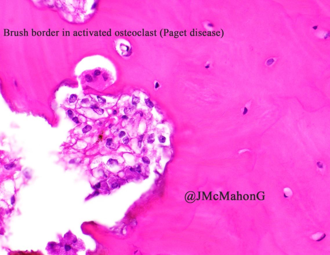 Nice example of the brush border of an activated osteoclast in Paget disease. 

This consultation was received to exclude metastatic carcinoma. 

Radiology showed lytic regions admixed with coarse trabeculae.

 No carcinoma here just Paget disease. 

#BSTPath