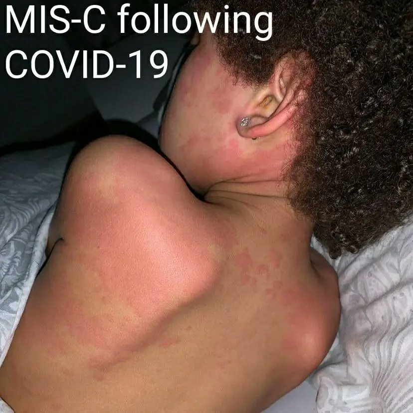 Multisystem Inflammatory Syndrome In Children (MIS-C) occasionally follows infection with COVID-19. Inflammation of the organs, including the skin, can result. A skin rash is a symptom in some, but not all. It's serious, although most children recover. #MedTwitter
