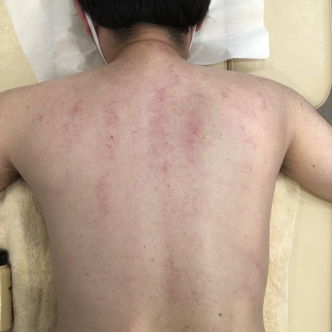 おばら 青森八戸ともす鍼灸整骨院 お昼休みに理学療法士の先生にカッサをやってもらいました 皮膚が赤くなっていますが やってもらってる最中もその後も痛みはなく なんだか背中が温かい感じです さて 午後の営業も元気よく行こう カッサ おばら 青森八戸ともす鍼灸整骨院 お昼休みに理学療法士の先生にカッサをやってもらいました 皮膚が赤くなっていますが やってもらってる最中もその後も痛みはなく なんだか背中が温かい感じです さて 午後の営業も元気よく行こう カッサ