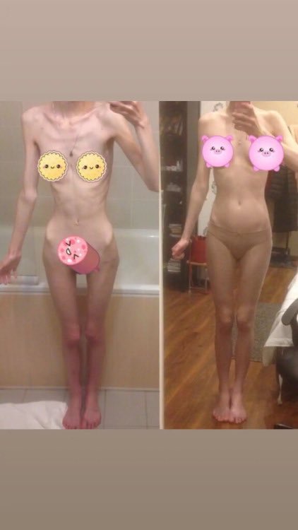 buniispo's tweet photo. th!nspo
#thinspo #thinsp0 #proana #proanatwt #EDtwt #bonespo 
-
-
-
-
-
- https://t.co/QpW4dBIs8t