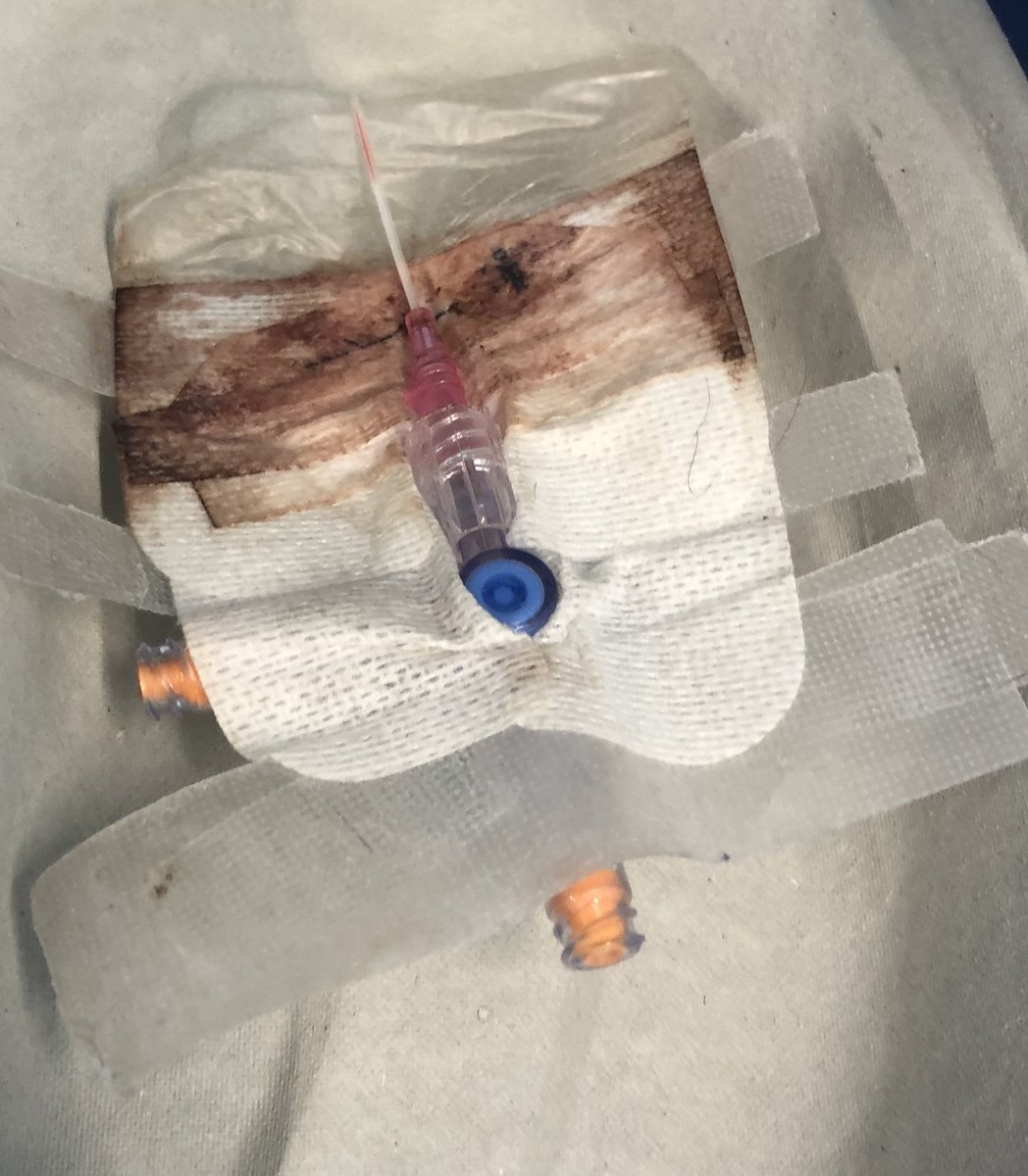 Co las fotos solo pretendemos crear cultura de las buenas prácticas en AV . Primordial comenzar con lo básico el PIVC  y el cambio de aposito c/7 d a no ser que esté despegado, sucio o saturado. Algo muy basico aunque viendo esto a veces uno tiene sus dudas. Abrimos debate