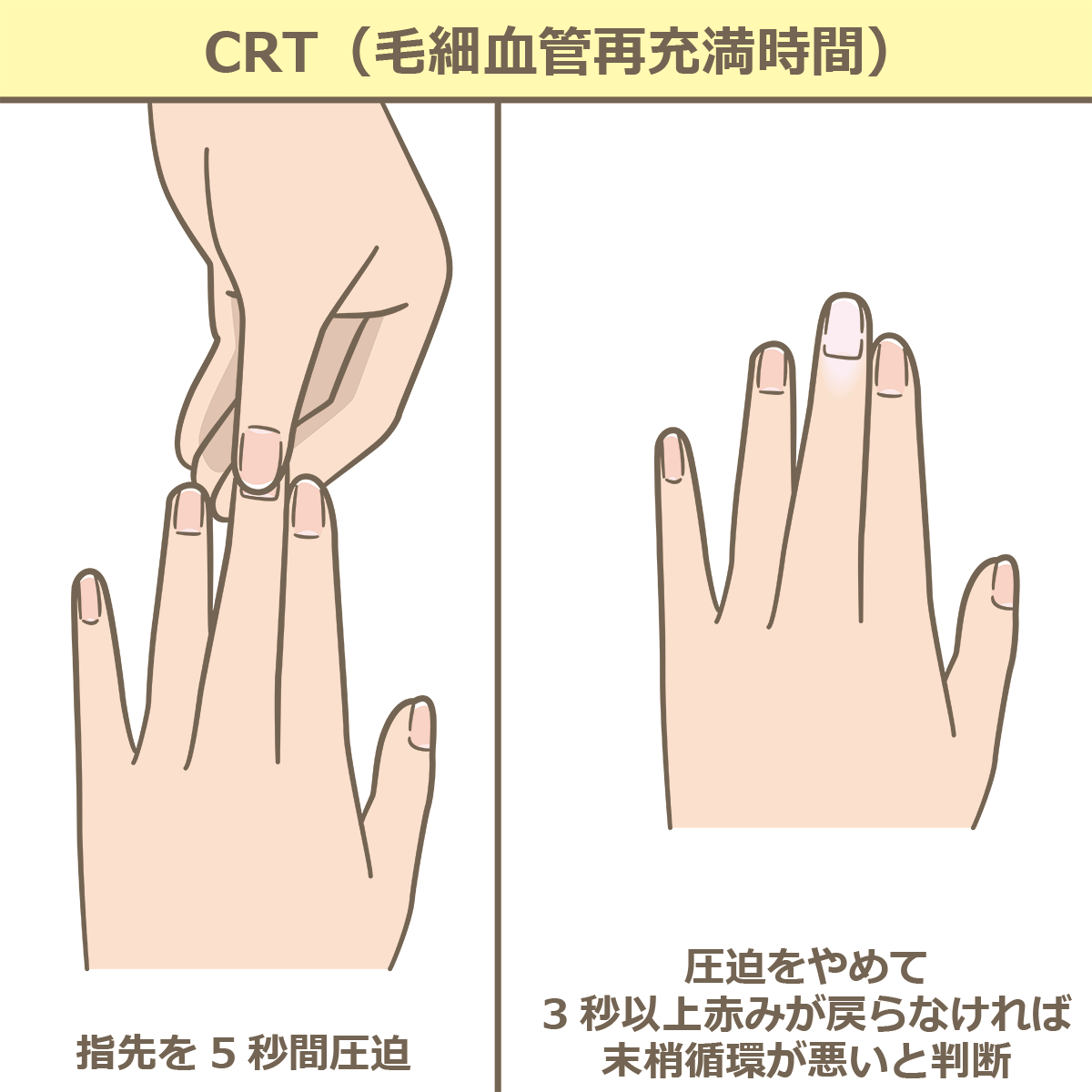 CRT(毛細血管再充満時間)のイラストです。
指先を5秒間圧迫し、圧迫をやめて3秒以上赤みが戻らなければ末梢循環が悪いと判断します。

#フリーイラスト 
#フリー素材 
#看護師イラスト集

看護師🎨イラスト集
CRT(毛細血管再充満時間)のイラスト
https://t.co/jsNdPm18iQ 