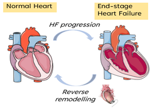 AaronHGunawan's tweet photo. The🎯for LVAD-induced reversal of #HeartFailure is garnering attention.

Yet, routine assessment of the changes in residual cardiac function that occur during LVAD support remains a challenge.

Non-invasive pressure-volume (PV) loops could offer a solution🧐

#SVCRS2021 1/5 https://t.co/6l6kUVUhOY