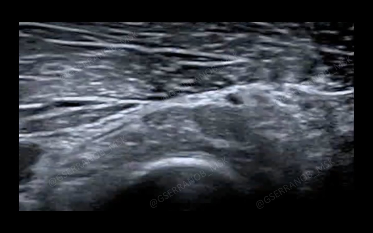 GSERRANOB_MSK's tweet photo. Posterior interosseous nerve syndrome. 

Illustrations from previous video. 

#mskrad https://t.co/Os357kw10W