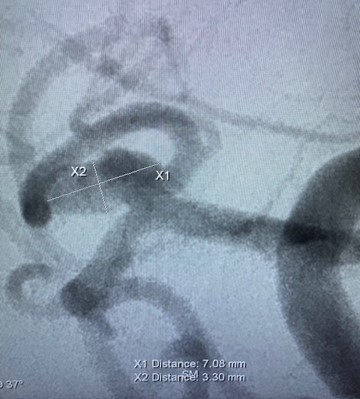 Rapid Medical (@rapid__medical) on Twitter photo Dr. <a href="/MajidiShahram/">Shahram Majidi, MD</a>. from <a href="/MountSinaiNeuro/">Mount Sinai Neurosurgery</a> NY, shares his recent MCA bifurcation aneurysm assisted coiling by #Comaneci17. The #Comaneci, delivered through an SL-10, has been placed in the superior division providing great support and scaffolding for the coils to sit properly. Dr. <a href="/MajidiShahram/">Shahram Majidi, MD</a>. from <a href="/MountSinaiNeuro/">Mount Sinai Neurosurgery</a> NY, shares his recent MCA bifurcation aneurysm assisted coiling by #Comaneci17. The #Comaneci, delivered through an SL-10, has been placed in the superior division providing great support and scaffolding for the coils to sit properly.