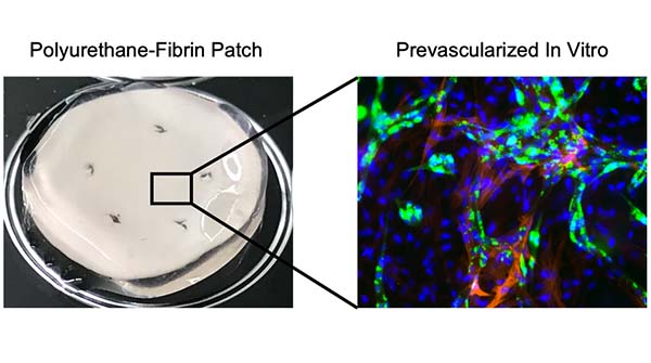 Advanced Portfolio News (@advportfolio) on Twitter photo Pretreatment of this patch with carefully selected cell populations improved heart function after surgery in an animal study
This work seeks to improve treatment of congenital heart defects <a href="/cosgriffhernan/">Elizabeth Cosgriff-Hernandez</a> <a href="/JacotLab/">Jacot Lab For Pediatric Regenerative Medicine</a> <a href="/CUDenverBIOE/">CU Denver Bioengineering</a>
Read the article: ow.ly/p7mn50GrfNI Pretreatment of this patch with carefully selected cell populations improved heart function after surgery in an animal study
This work seeks to improve treatment of congenital heart defects <a href="/cosgriffhernan/">Elizabeth Cosgriff-Hernandez</a> <a href="/JacotLab/">Jacot Lab For Pediatric Regenerative Medicine</a> <a href="/CUDenverBIOE/">CU Denver Bioengineering</a>
Read the article: ow.ly/p7mn50GrfNI