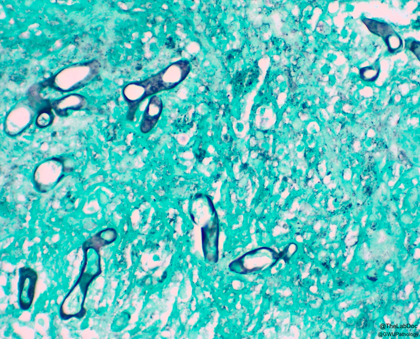 TheLabDoc's tweet photo. 40s🚹
CoVID+; few days intense headache & facial pain+++
New Dx of DM; HbA1c 9
MRI; palate & maxilla showed:
#PathTwitter #PathResidents #MicroRounds #MicroMed #IDTwitter #MedStudentTwitter #MedTwitter https://t.co/sHjJsEbFzd