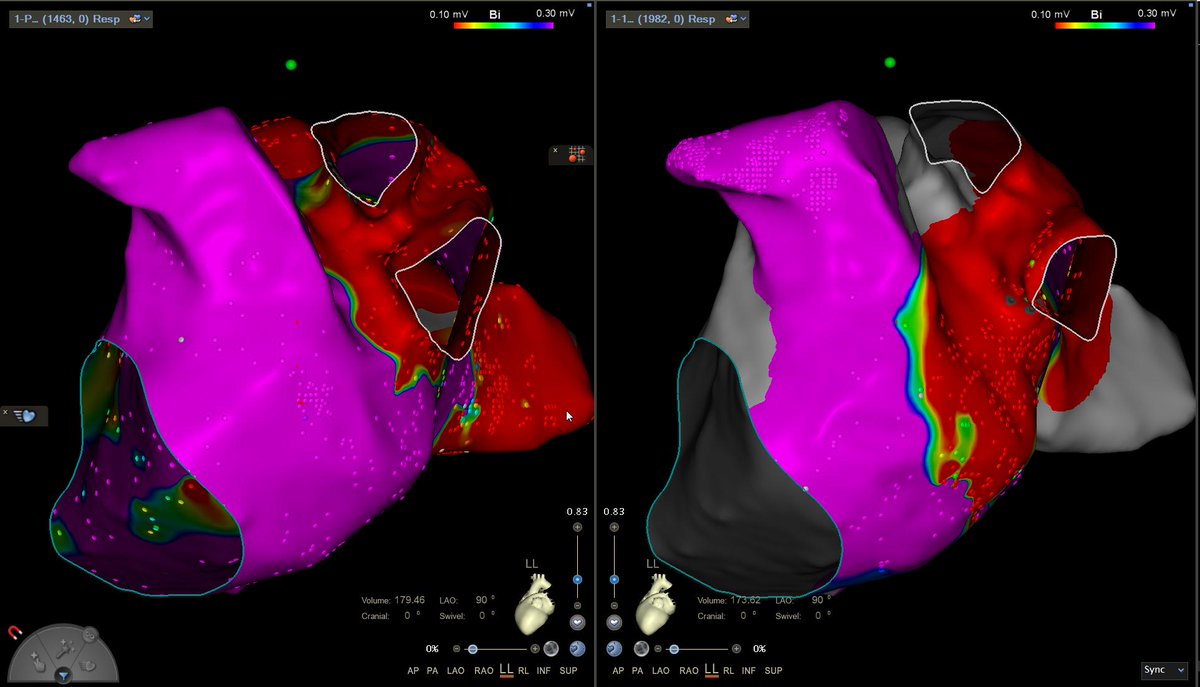 VOM Ethanol infusion today at <a href="/cardiopdh/">Cardiología Puerta de Hierro🫀</a>.Nice work together with <a href="/Hemo_HPDH/">Interventional Cardiology HPDH</a> . Great increse in scar area.<a href="/CampusArritmias/">Campus de Arritmias</a> <a href="/ifdezlozano/">IFLozano</a> <a href="/JorgeToquero/">Jorge Toquero</a> <a href="/UseGarIzq/">Use Garcia-Izquierdo</a> <a href="/Dieji11/">Diego Jiménez Sánchez</a> <a href="/melodiesegurad/">melodiesegura</a> @darwinveloza <a href="/JoeMorillo23/">Joel D. Morillo Diaz</a> <a href="/TiroriiTirora/">Paula Vela</a> <a href="/DocNanoG/">Daniel García Rodríguez</a>