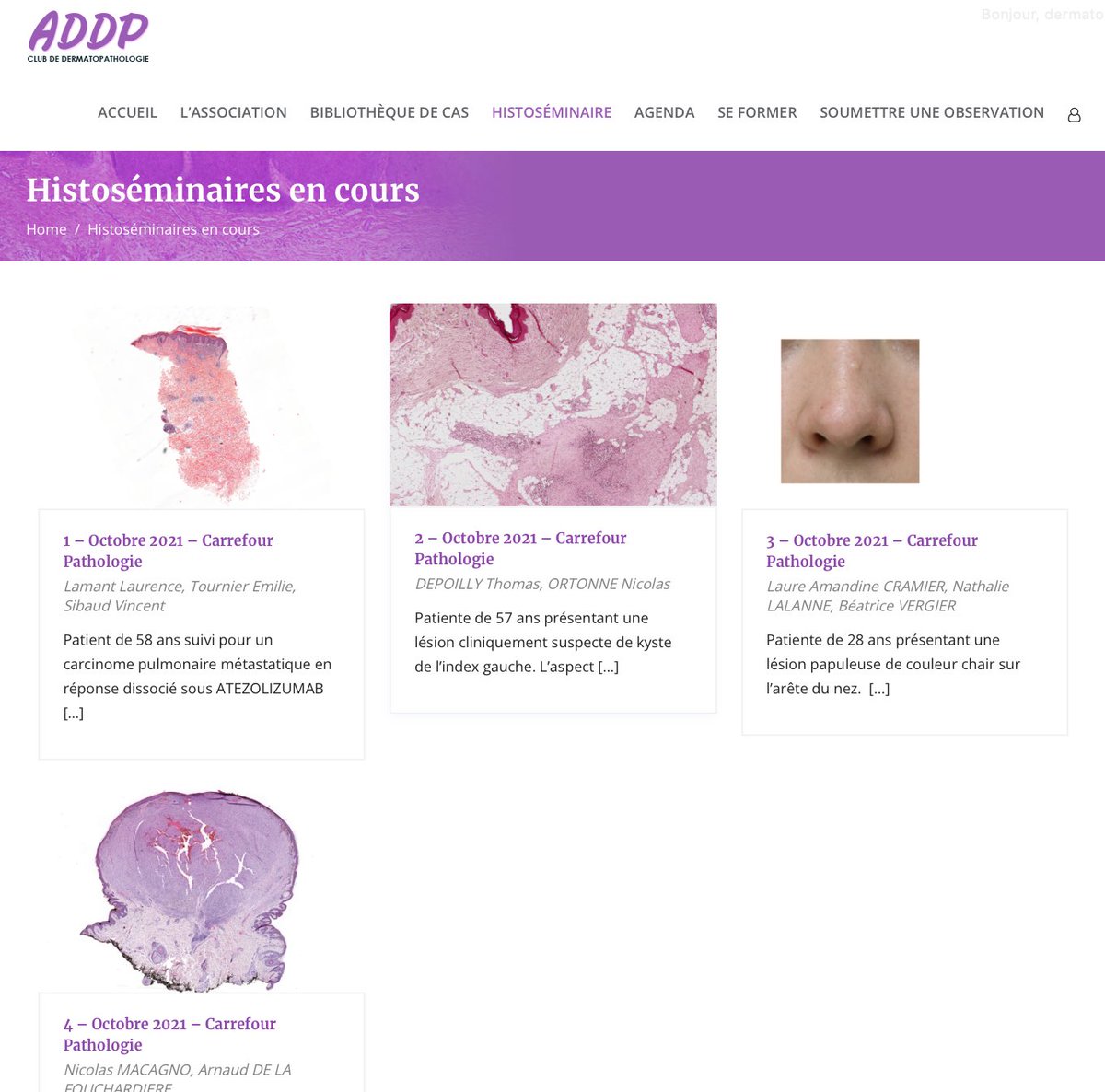 #carrefourpathologie2021

découvrez les différents cas présentés au 
CLUB DE SPECIALITE DE DERMATOPATHOLOGIE 
sur le site de l’ADDP en suivant ce lien :

dermatopathologie.fr/histoseminaire…

<a href="/DermatopathFR/">Dermatopathologie 🇫🇷</a> <a href="/melanopath/">Arnaud de la Fouchardiere MD, PhD</a> @BeatriceVergier