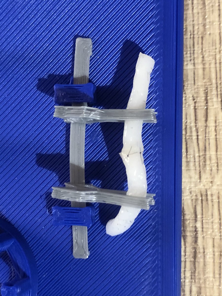 Gemma (@glb______) on Twitter photo Having a lovely evening performing microsurgical anastomoses on these adorable little noodles 🍜
Thank you <a href="/Stelth_Tech/">Stelth</a> ❤️
<a href="/BSSHand/">British Society for Surgery of the Hand</a> <a href="/BAPRASvoice/">BAPRASvoice</a> <a href="/PLASTAUK/">PLASTA</a> Having a lovely evening performing microsurgical anastomoses on these adorable little noodles 🍜
Thank you <a href="/Stelth_Tech/">Stelth</a> ❤️
<a href="/BSSHand/">British Society for Surgery of the Hand</a> <a href="/BAPRASvoice/">BAPRASvoice</a> <a href="/PLASTAUK/">PLASTA</a>