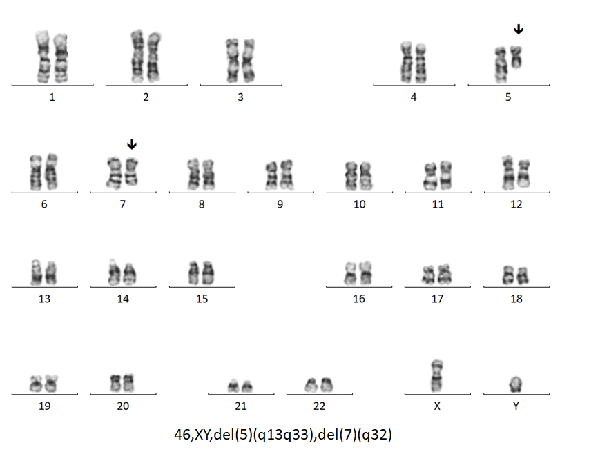 Bone marrow G-band analysis from a 72 year old man with MDS showing del5q and del7q indicating likely abnormal TP53 and cryptic genomic complexity and conferring, sadly, a poor prognosis. For a great article on this topic, check out: nature.com/articles/s4140…