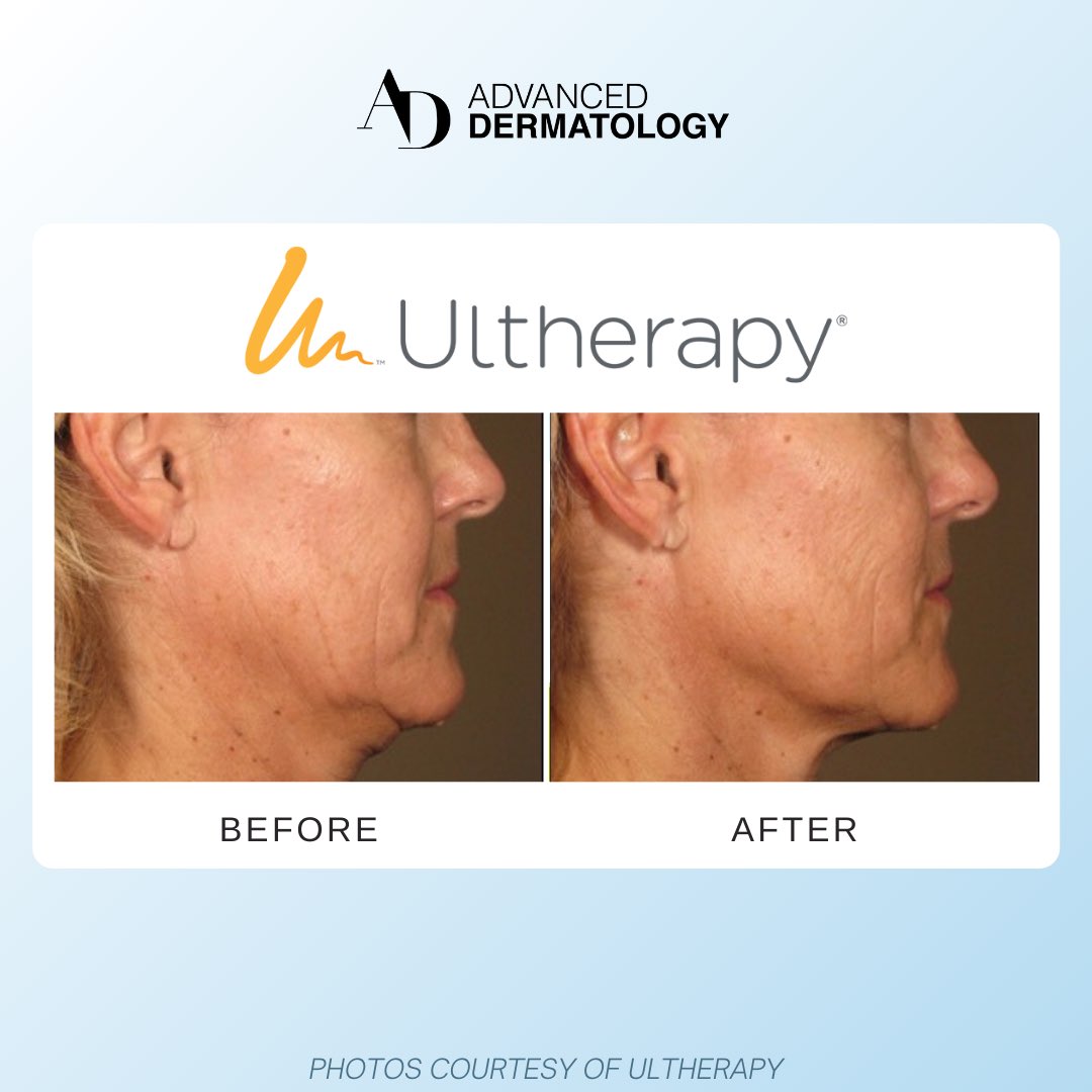 advanced_derm's tweet photo. Results worth bragging about, courtesy of @Ultherapy Take advantage of our #Ultherapy special running the whole month of October! 10% ONE AREA, 15% OFF TWO AREAS, 20% OFF FULL FACE AND NECK - SAVE UP TO $900! Available only at our #Katy and #SugarLand locations only https://t.co/CAigynEDSD