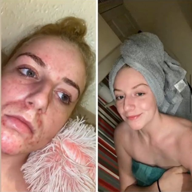 Amazing Skin Story 🙌
Results from using our Premium Capsules 🥦🍎🍇
DM me for more info 📩