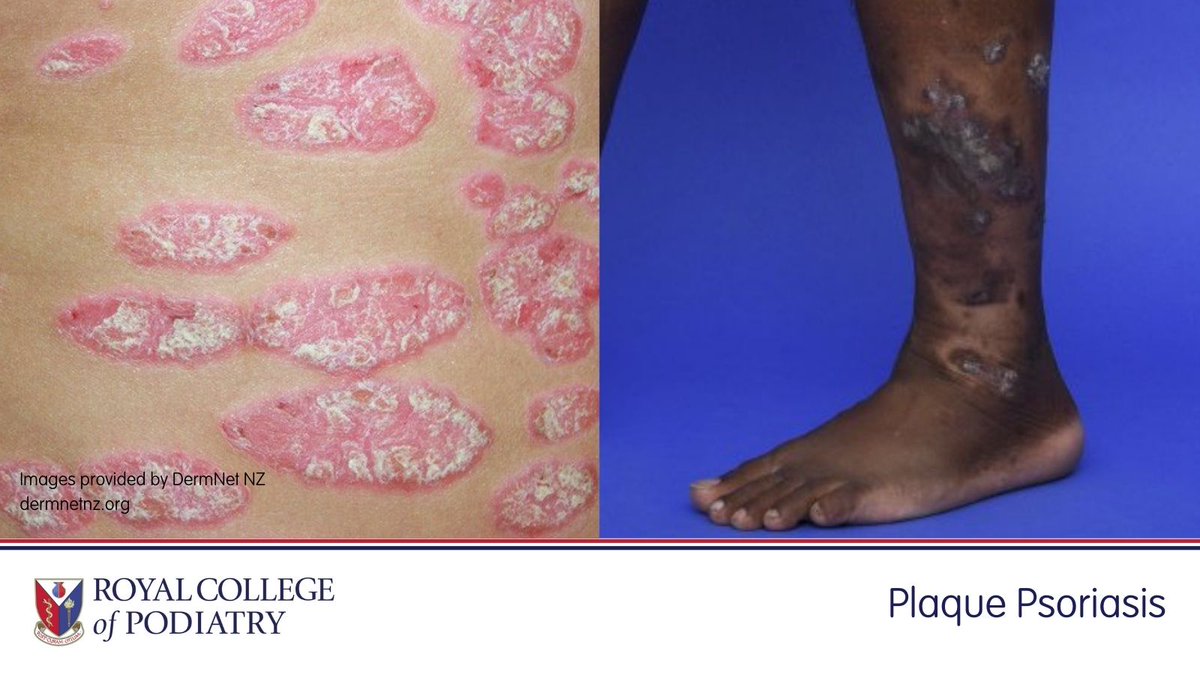 RoyColPod's tweet photo. This #BlackHistoryMonth, we recognise the historic inequality in healthcare teaching. Conditions present differently depending on skin pigmentation. We pledge to do better as an organisation, ensuring that we represent the diagnostic criteria needed to increase health equality. https://t.co/GLIb0Dt4zH