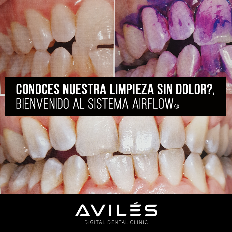 drpabloaviles's tweet photo. El dispositivo más avanzado para limpieza dental y periodoncia es el sistema AirFlow® Profilaxys Master. Infórmate en: https://t.co/SCpU6B7gnc https://t.co/WQLSH7DTgD