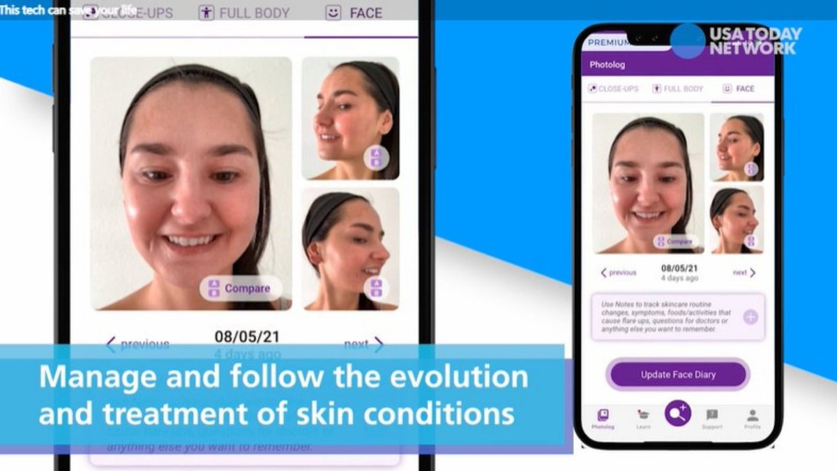 USA TODAY describes how Emily Riggs, a melanoma survivor, uses Miiskin's telehealth technology and platform together with her dermatologist for the early detection of #skincancer.

msn.com/en-ca/news/tec…

#dermatology #telehealth #skincancerprevention #usatoday