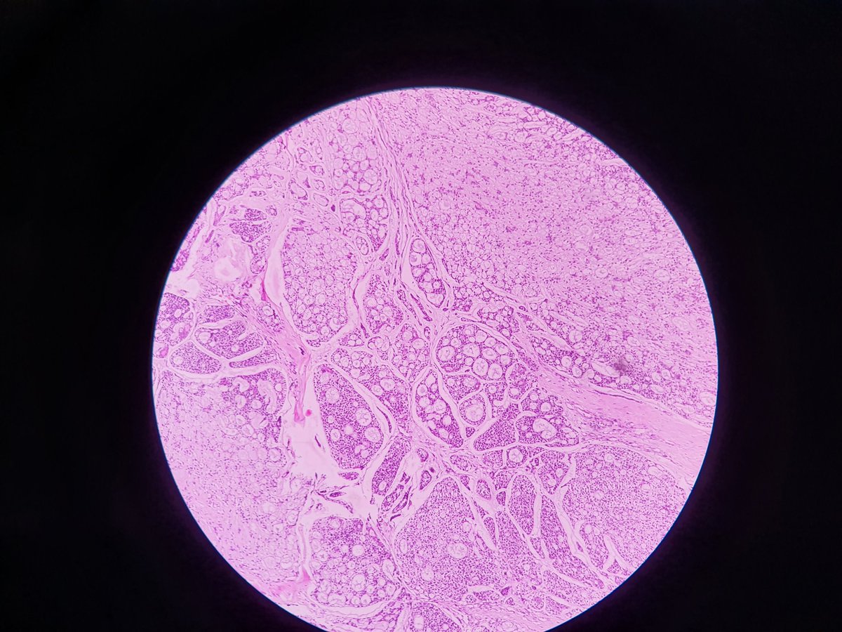 Janoroy24's tweet photo. 50 year old male,minor salivary gland excision.
Look at those invaders..!! #Pathology #headandneck https://t.co/wOCbPDovv7