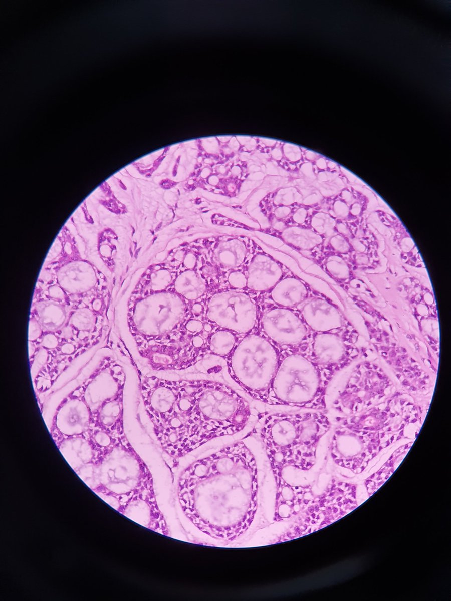 Janoroy24's tweet photo. 50 year old male,minor salivary gland excision.
Look at those invaders..!! #Pathology #headandneck https://t.co/wOCbPDovv7