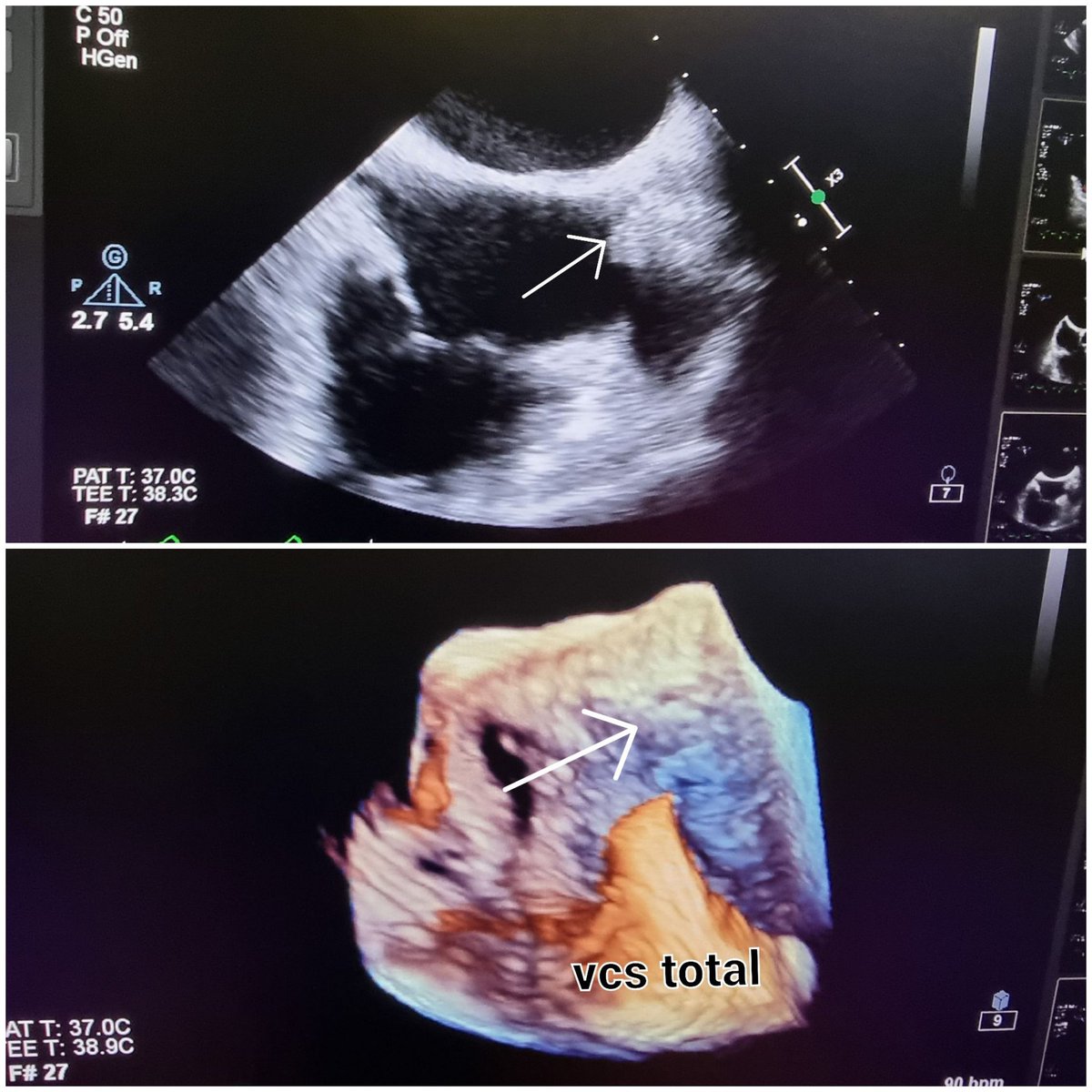 Yusuf Karavelioğlu (@dryusufkaraveli) on Twitter photo Tunneled dialysis catheter + vcs total.PTA + graft stent. Finally, we removed the long sheath and reinserted the tunneled catheter in the same way. There was no facial swelling due to prominent azygos vein #fistulafirst <a href="/wasse_m/">Monnie Wasse, MD, MPH</a> <a href="/Kardiyoloji_/">Prof. Dr. M. Kadri Akboğa</a> <a href="/NMawlaMD/">Neghae Mawla, MD</a> <a href="/ErsaTatl/">Prof.Dr. Ersan Tatlı</a> Tunneled dialysis catheter + vcs total.PTA + graft stent. Finally, we removed the long sheath and reinserted the tunneled catheter in the same way. There was no facial swelling due to prominent azygos vein #fistulafirst <a href="/wasse_m/">Monnie Wasse, MD, MPH</a> <a href="/Kardiyoloji_/">Prof. Dr. M. Kadri Akboğa</a> <a href="/NMawlaMD/">Neghae Mawla, MD</a> <a href="/ErsaTatl/">Prof.Dr. Ersan Tatlı</a>