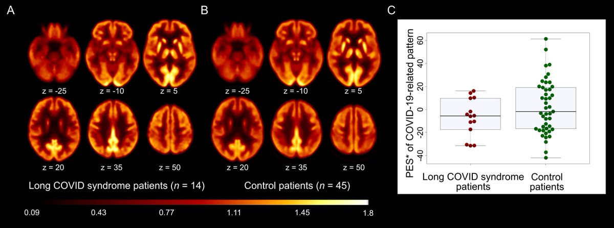 New findings suggest that underlying causes of long COVID might be related to fatigue but not to persistent cortical dysfunction. ow.ly/935050Gs3o3

#Medicalimaging #PETimaging #LongCovid #Covid