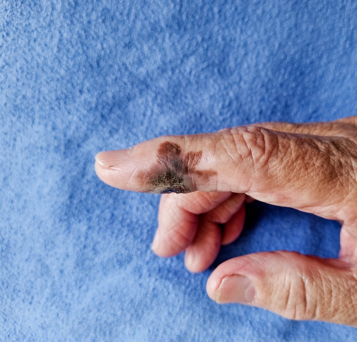 gusgutierrez92's tweet photo. Vamos a aprovechar el caso de hoy para recordar el ABCDE del melanoma.
Lesión con 3 años de evolución, tratada con ajo y despigmentantes.
Ante cualquier "lunar" sospechoso acudan al DERMATÓLOGO. https://t.co/IR11myU1R7