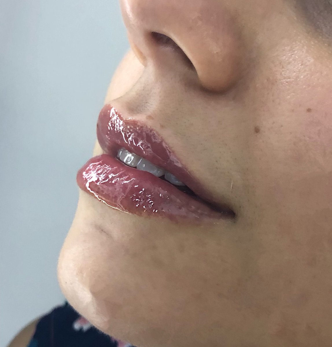 Anna__Portela's tweet image. To muito apaixonada pelo meu trabalho, nem parece q foi eu que fiz 🙏🏻🥰 Obrigada Deus #preenchimentolabial