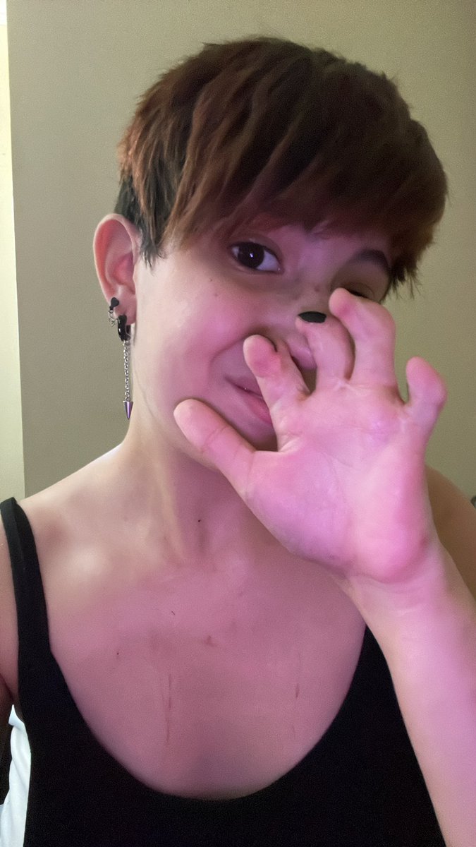 RoyalTikky_XOXO's tweet photo. My brother's theory is those with EDS and Syndactyly are Mermaids. Our bodies are aching so much because in water we're weightless and now that we're on land our bodies are NOT used to the Gravity. #LuckyFin
#EDS #Syndactyly #RealMermaids #SeaWitch #ADHD #ActuallyAutistic #OMG https://t.co/XctAKSlLtw